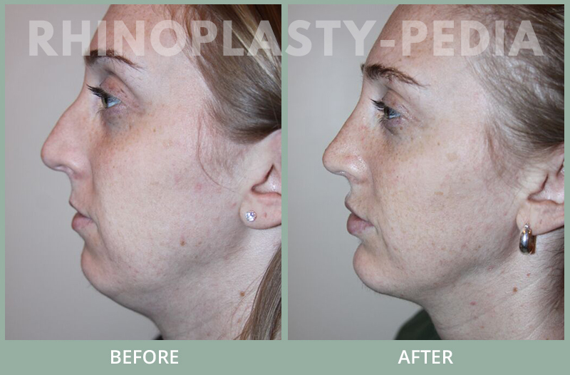 rhinoplasty female patient before and after photo set 120