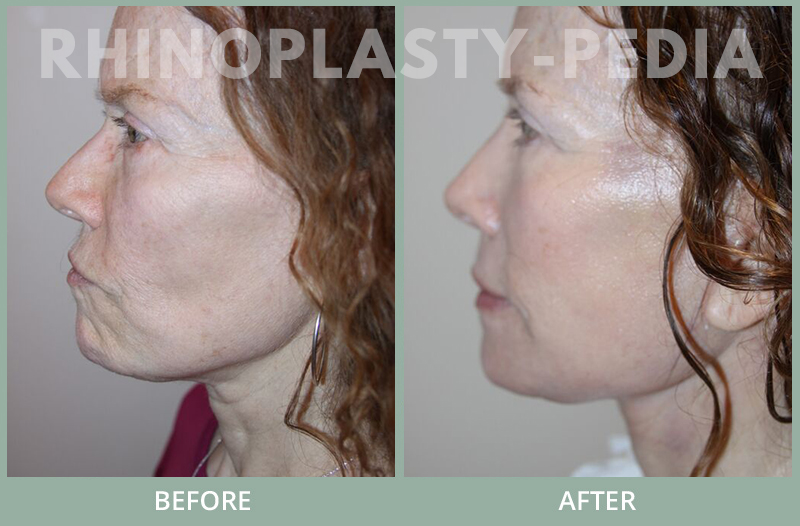 female rhinoplasty patient before and after photo 37