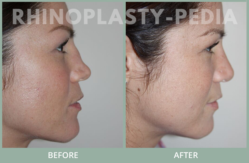 rhinoplasty female patient before and after photo set 124