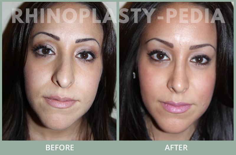 rhinoplasty female patient before and after photo set 125