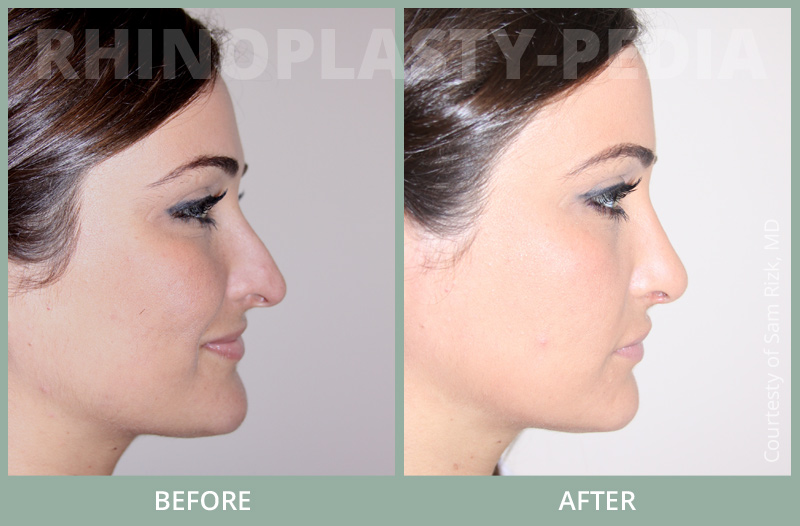 rhinoplasty female patient before and after photo set 61