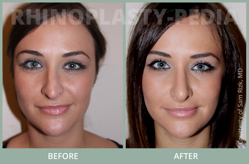 female rhinoplasty patient before and after photo 10