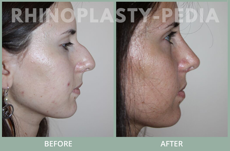 rhinoplasty female patient before and after photo set 129