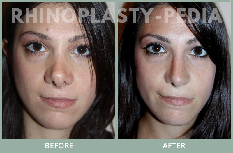 rhinoplasty female patient before and after photo set 129