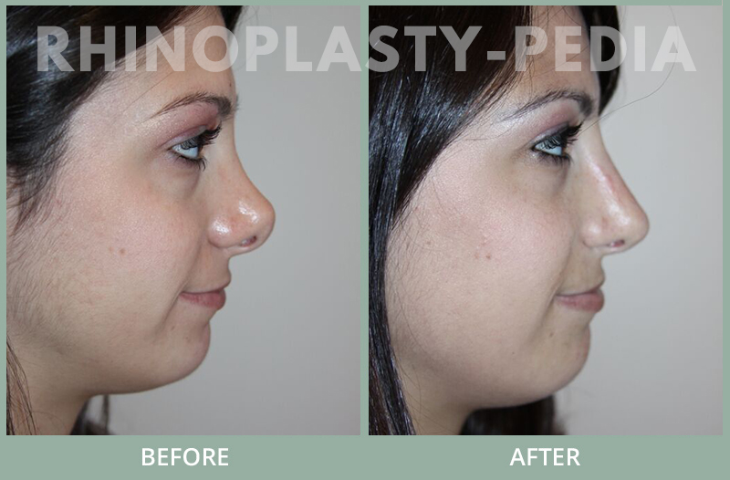 rhinoplasty female patient before and after photo set 130