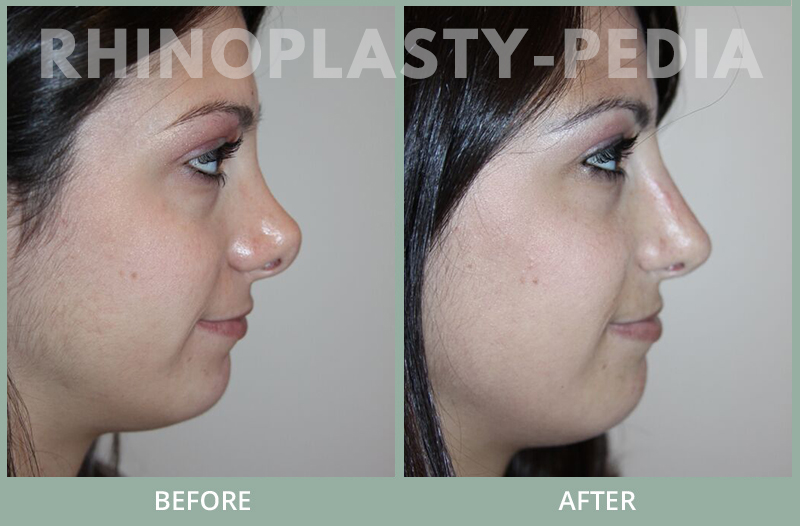 female rhinoplasty patient before and after photo 41