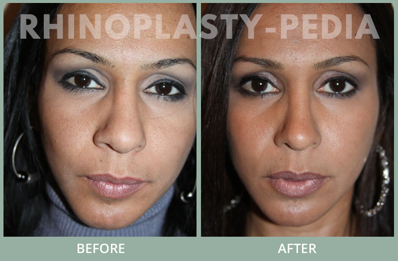 rhinoplasty female patient before and after photo set 78