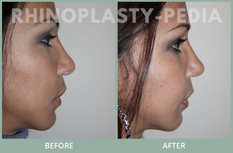 rhinoplasty female patient before and after photo set 79