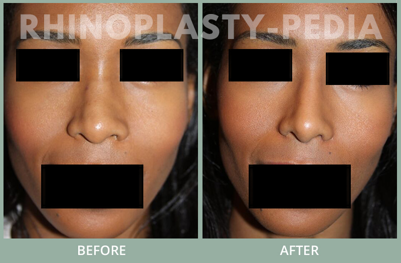 female rhinoplasty patient before and after photo 43