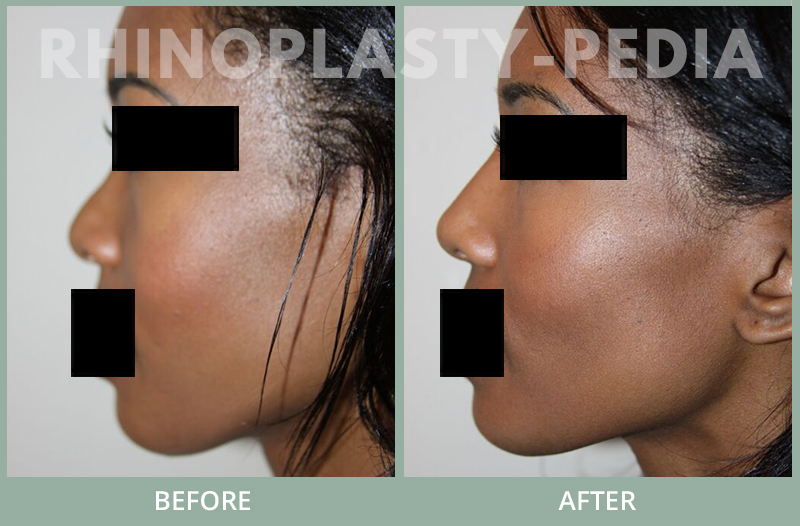 rhinoplasty female patient before and after photo set 76