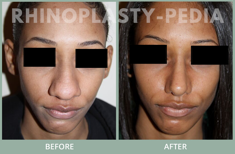 female rhinoplasty patient before and after photo 44