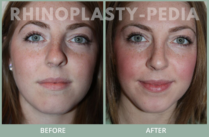 rhinoplasty female patient before and after photo set 70