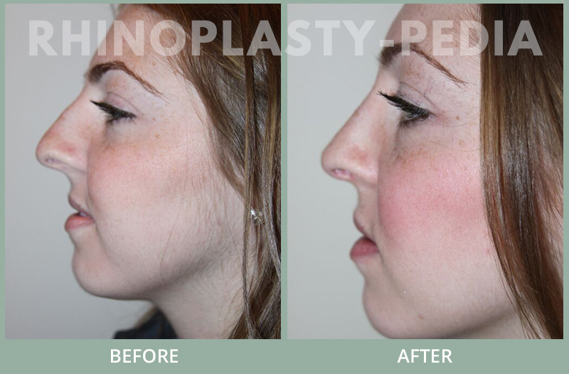 female rhinoplasty patient before and after photo 45
