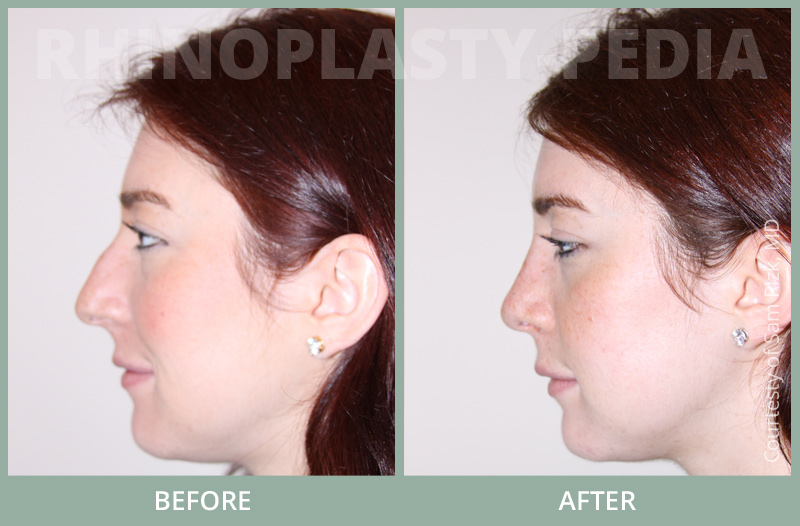 rhinoplasty female patient before and after photo set 59