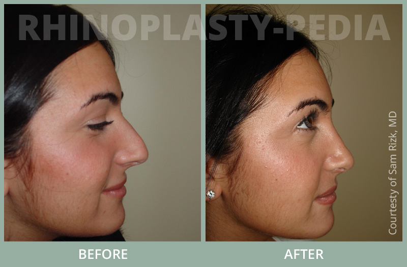 rhinoplasty female patient before and after photo set 58