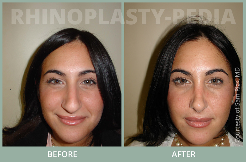 rhinoplasty female patient before and after photo set 59