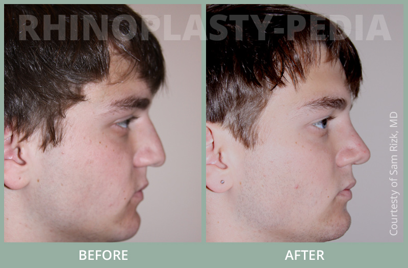 rhinoplasty male patient before and after photo set 11