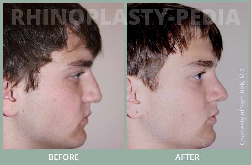 male rhinoplasty patient before and after photo 1