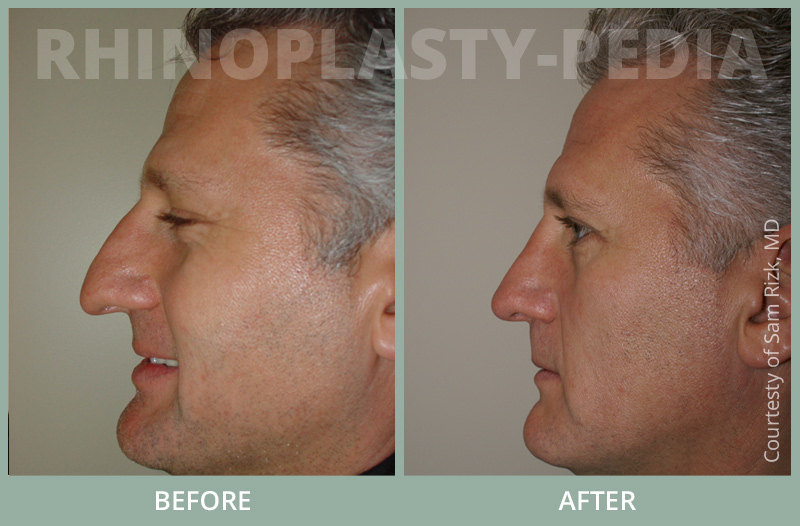 male rhinoplasty patient before and after photo 4