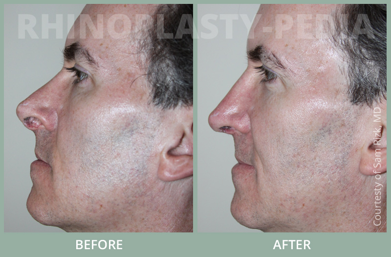 rhinoplasty male patient before and after photo 3