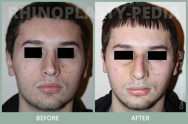 male rhinoplasty patient before and after photo 11
