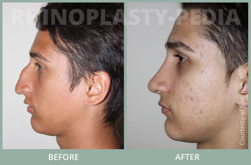 rhinoplasty male patient before and after photo set 22