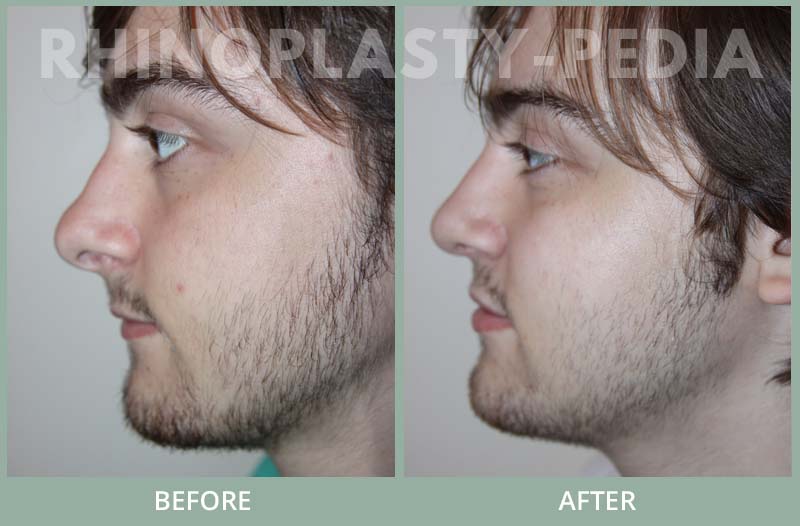 male rhinoplasty patient before and after photo 9