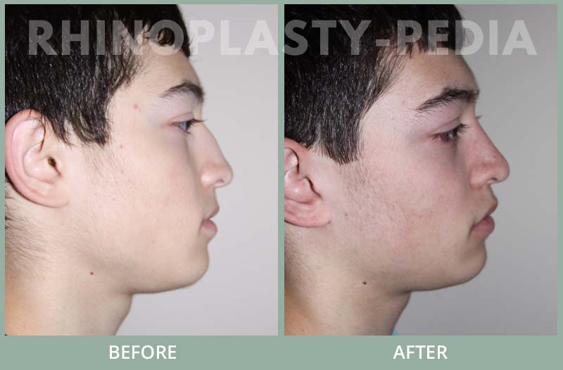 rhinoplasty male patient before and after photo set 35