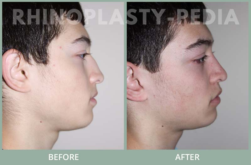 male rhinoplasty patient before and after photo 10