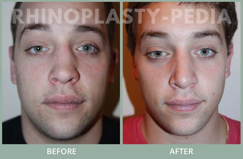 rhinoplasty male patient before and after photo set 41