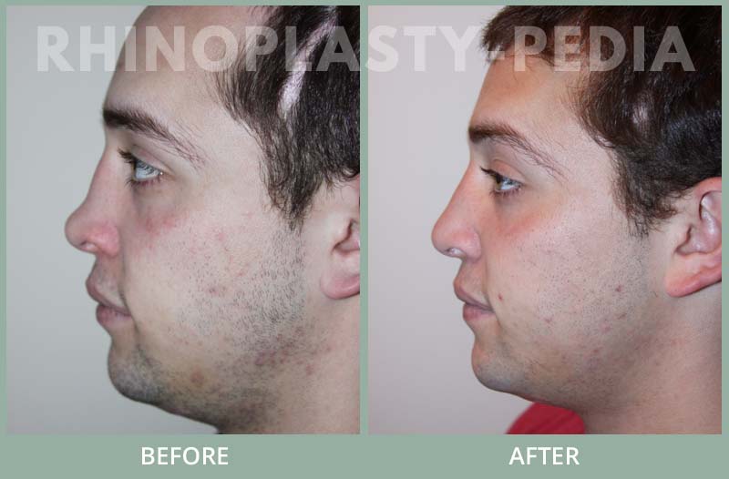 rhinoplasty male patient before and after photo set 42