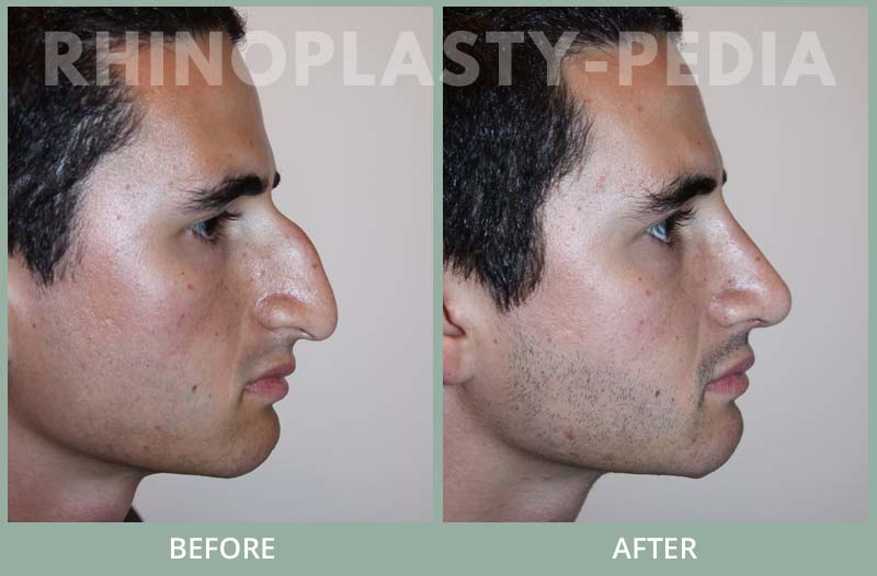 rhinoplasty male patient before and after photo set 44