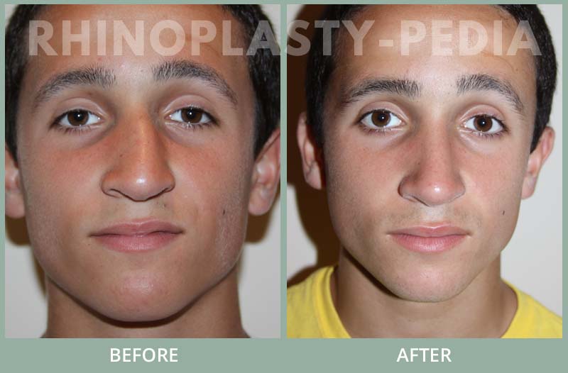 rhinoplasty male patient before and after photo 11