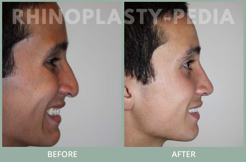 rhinoplasty male patient before and after photo set 46