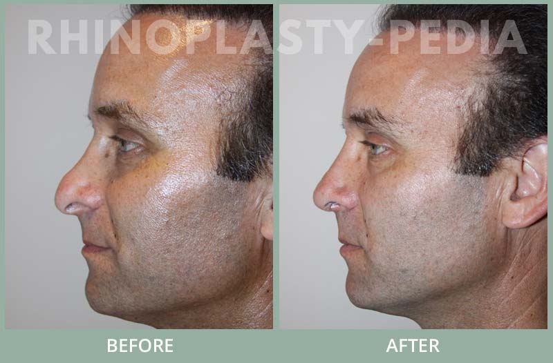 rhinoplasty male patient before and after photo set 48