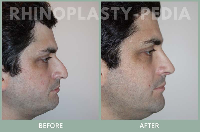 male rhinoplasty patient before and after photo 18