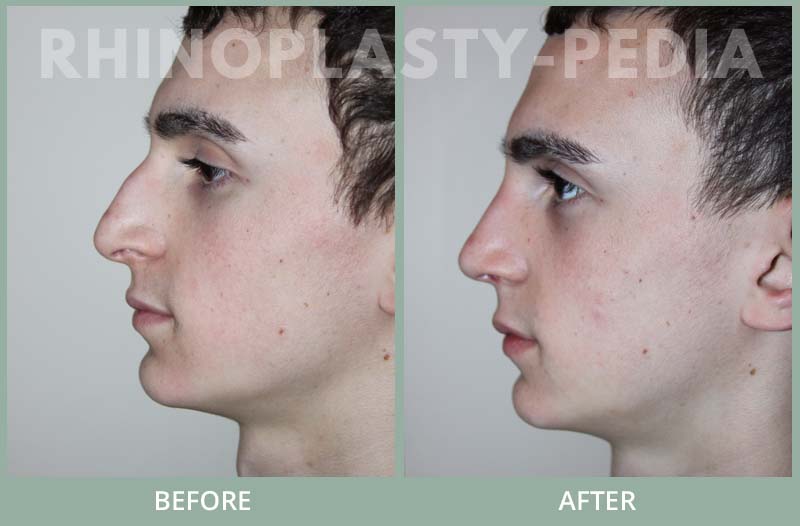 male rhinoplasty patient before and after photo 21