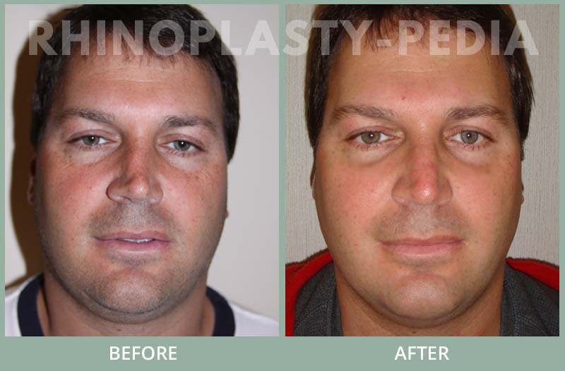 male rhinoplasty patient before and after photo 23