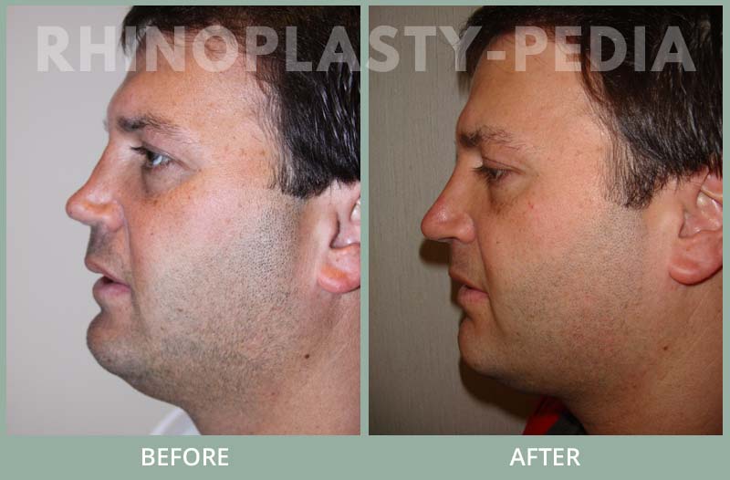 rhinoplasty male patient before and after photo set 53