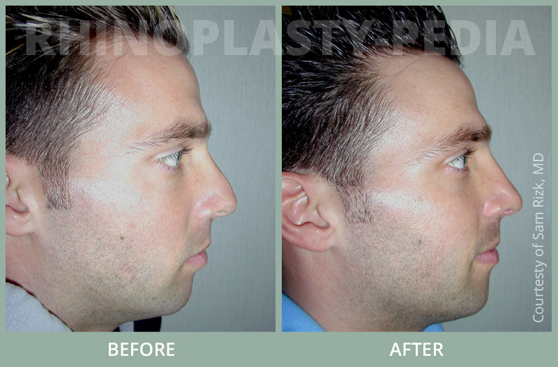 rhinoplasty male patient before and after photo set 28