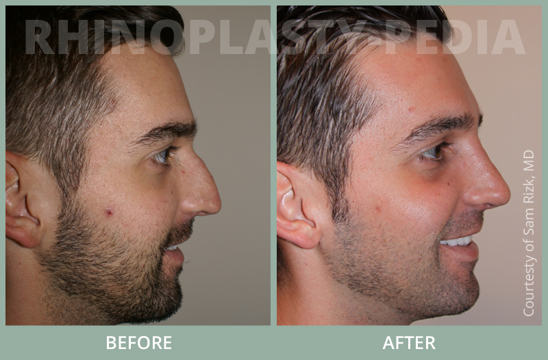 male rhinoplasty patient before and after photo 3
