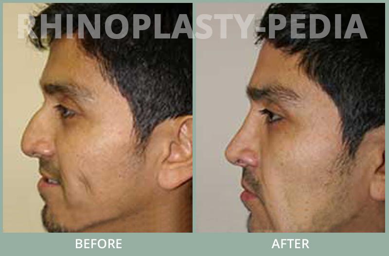 rhinoplasty female patient before and after photo set 60