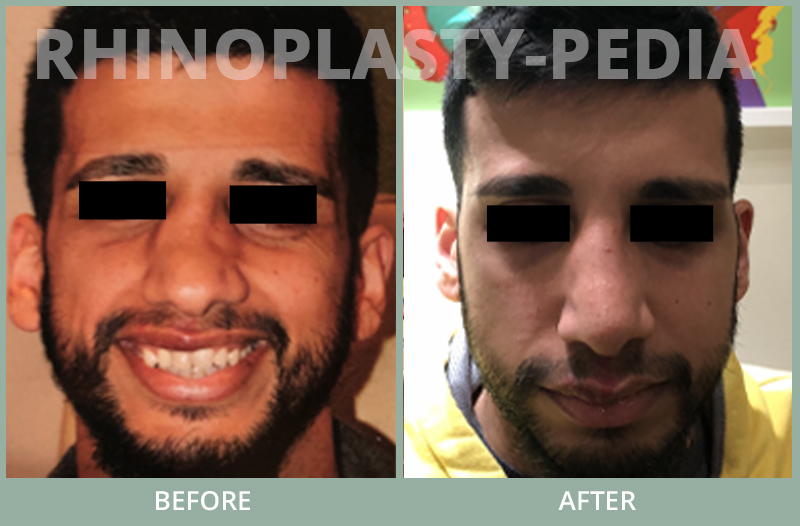 rhinoplasty female patient before and after photo set 80