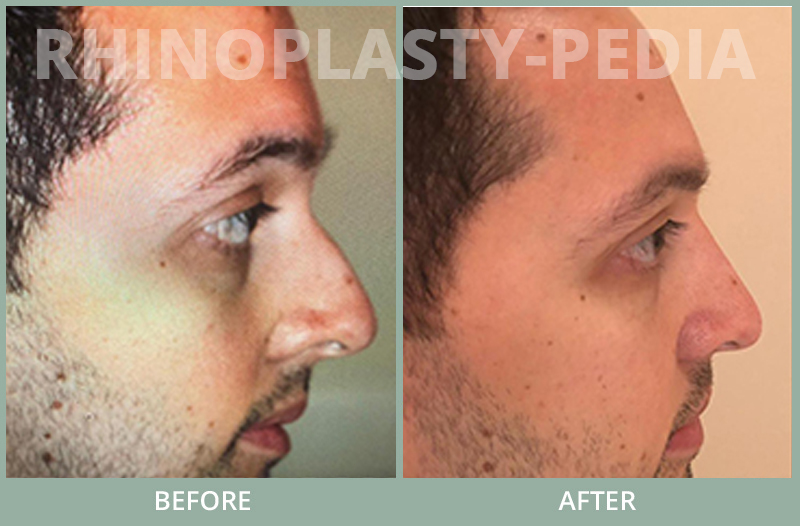 male rhinoplasty patient before and after photo 79