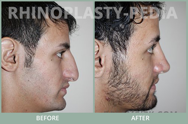 male rhinoplasty patient before and after photo 79