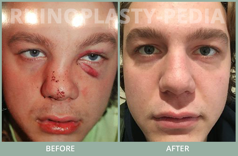 rhinoplasty female patient before and after photo set 62