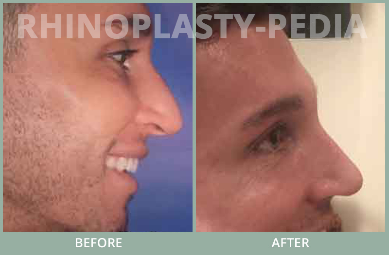 rhinoplasty female patient before and after photo set 63