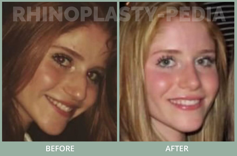 Patient sent her postop pictures 2 years after rhinoplasty compared to same time before