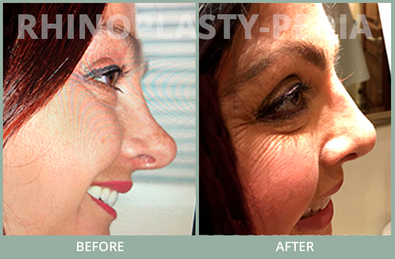 rhinoplasty female patient before and after photo set 75