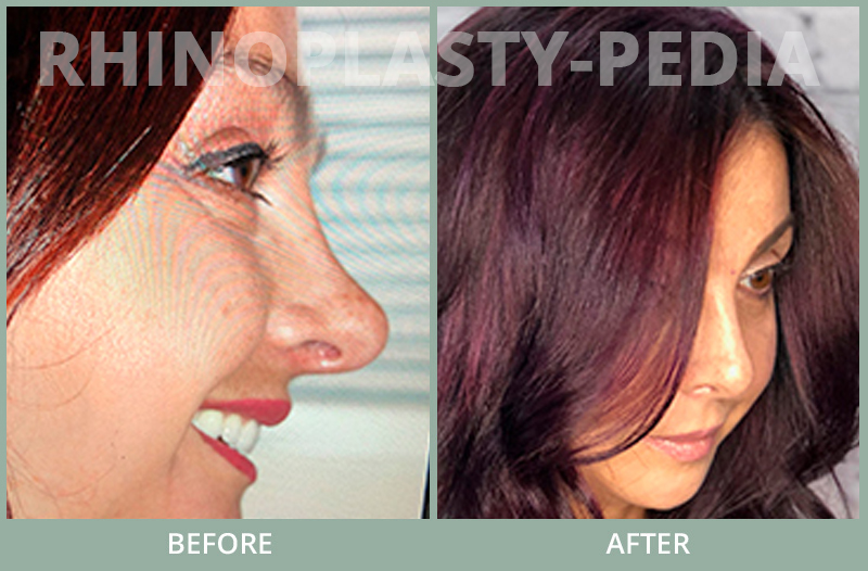 rhinoplasty female patient before and after photo set 75